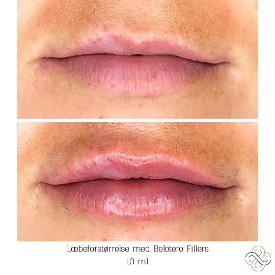 abnikka-fillers-læbeforstørrelse-belotero-lips-art-by-nikka