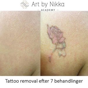abnikka-academy-yaglaser-resultat-ecuri-tattoo-removal