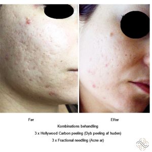 abnikka-ansigtsbehandling-hudproblemer-acne-ar-peeling-art-by-nikka