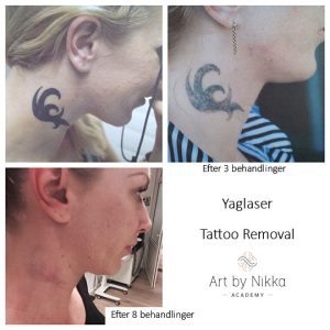 abnikka-yaglaser-uddannelse-ecuri-tattoo-removal